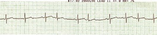 EKG 18 - Sinus rhythm with PACs