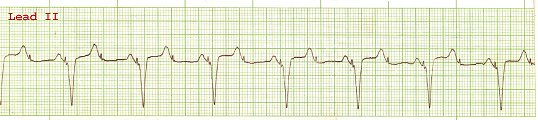 EKG 71 - DDD Pacemaker in VAT mode - Intermittent capture