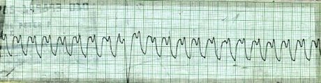 EKG 57 - V Tach