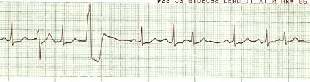 EKG 33 - Sinus with PACs and PVCs