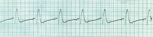 EKG 55 - Sinus Tachycardia - Mobitz type II