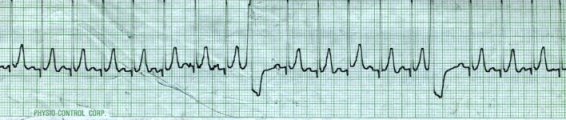 EKG 58 - Sinus Tach with PVCs