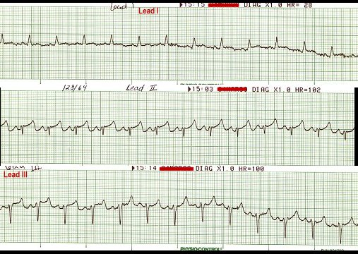 EKG 65 - Sinus Tachycardia