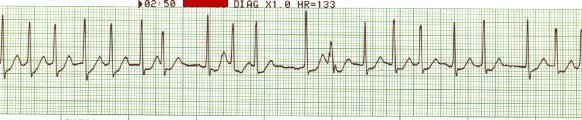 EKG 66 - Rapid Atrial Fibrillation