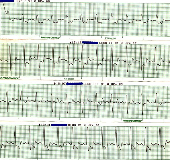 EKG 78