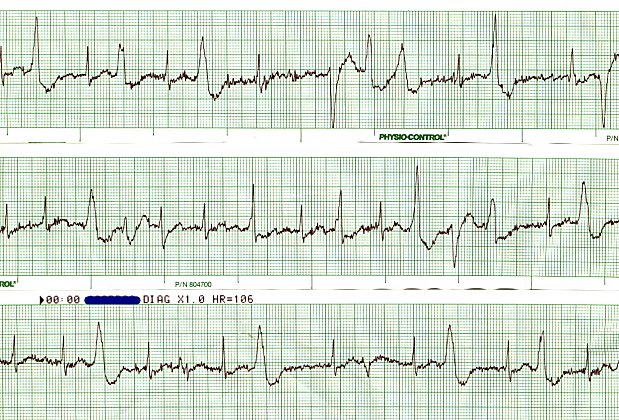 EKG 82 - Multiformed PVCs - coupling