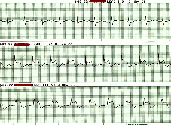 EKG 91 - Acute Inferior MI