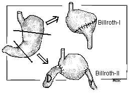 Billroth