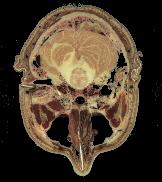 Corte cerebral