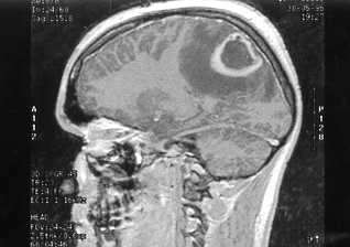 Absceso