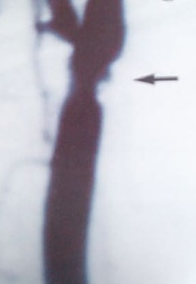 AORTA