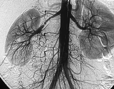 Estenosis arteria renal
