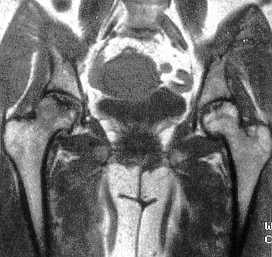 Necrosis avascular de caderas