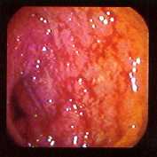 Colitis ulcerosa