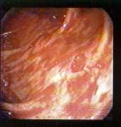 Colitis ulcerada