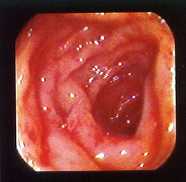 Colitis ulcerosa