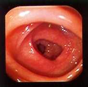 Colon sigmoide