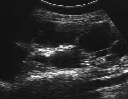 Ecograf�a renal