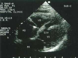 Comunicaci�n interventricular