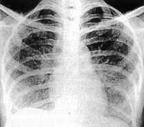 Esclerodermia