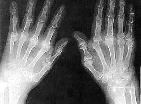 Artritis reumatoide