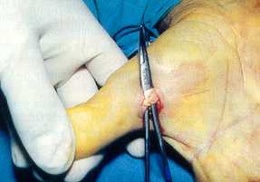 Tend�n flexor del pulgar