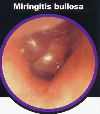 Miringitis bullosa