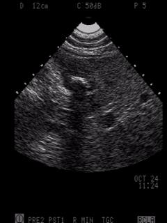 Litiasis Biliar