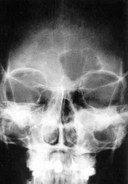 Pansinusitis