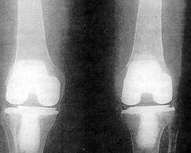 Pr�tesis de rodilla