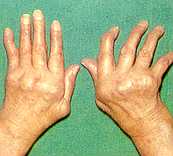 Artritis reumatoide