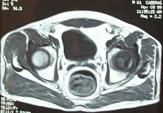 necrosis cadera