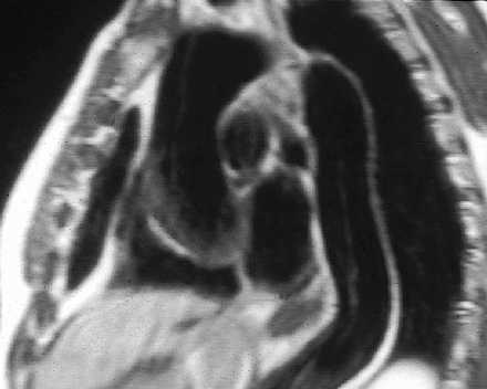 Disecci�n de Aorta tor�cica