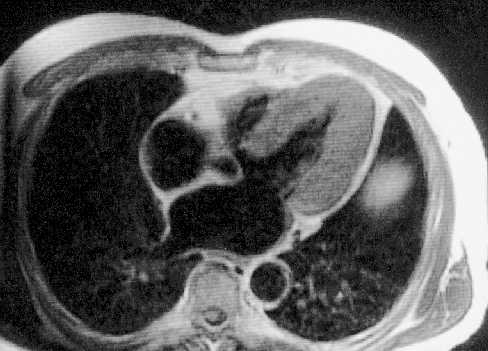 Hipertrofia VI.
