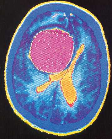 Tumor intracraneal con ramificaciones