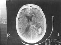 Hematoma