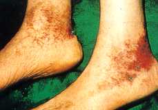 Vasculitis