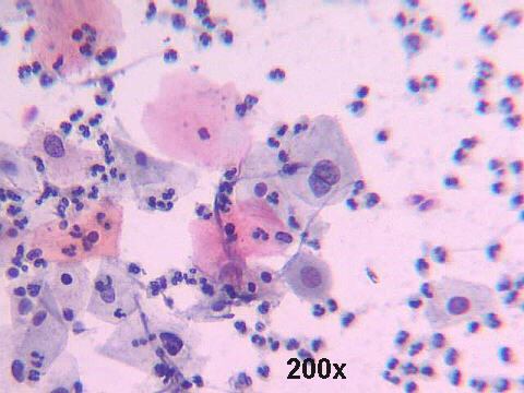 J. C. Prolla - Cytopathology esophagus: Low grade intraepithelial ...