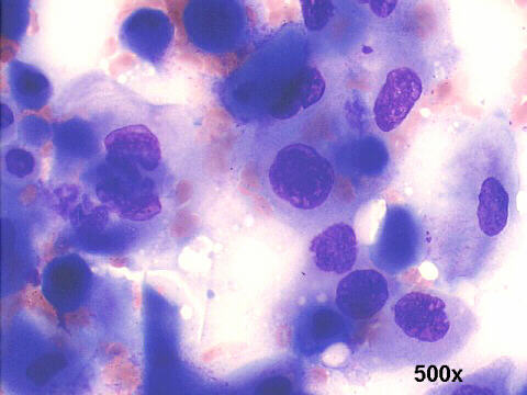 J. C. Prolla - Cytopathology Squamous cell carcinoma Pancoast tumor