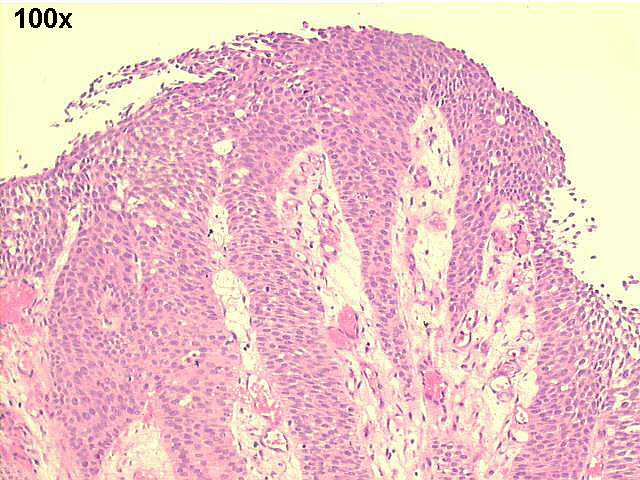 J. C. Prolla - Cytopathology case 01A 2007 Papillary urothelial ...