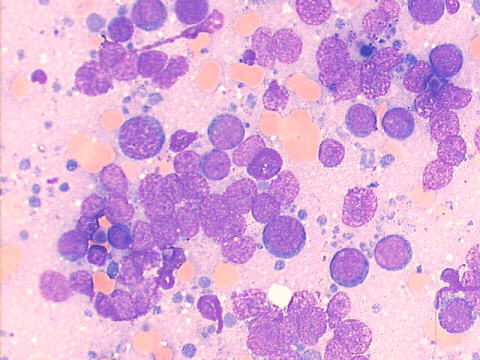 J. C. Prolla - Cytopathology case 08A 2005 Primary hepatic B-cell lymphoma.