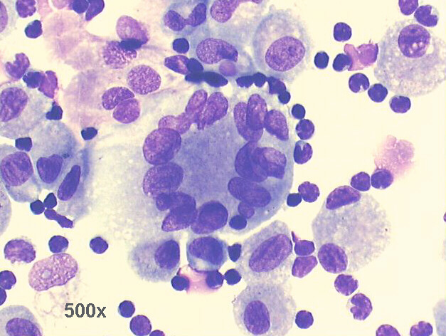 J. C. Prolla - Cytopathology BAL: lymphocytosis in miliary tuberculosis