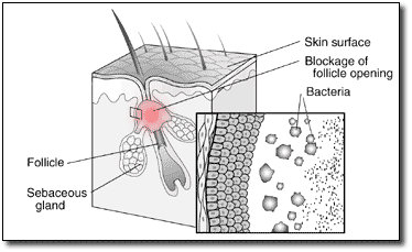 Causes of acne