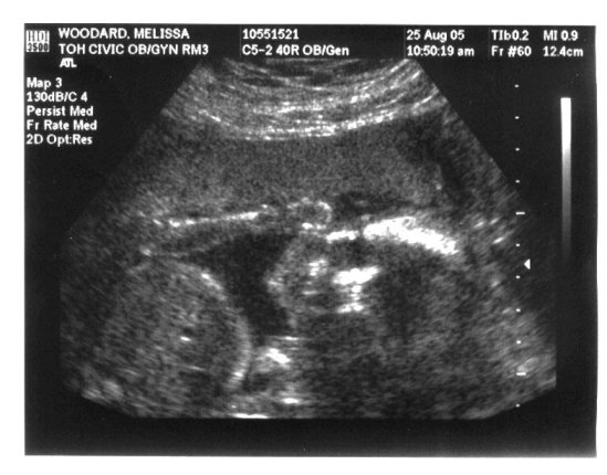 Ultrasound pics