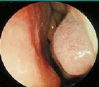 photo depicting allergic rhinitis: left nasal cavity