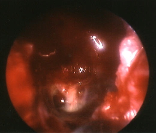 fistula site seen towards bottom left