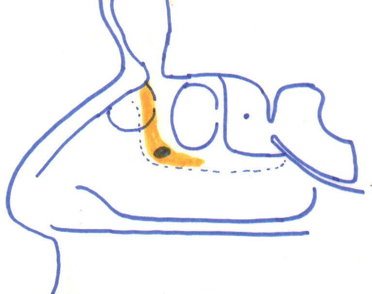 The lateral nasal wall with the middle turbinate removed to reveal the sinuses below.