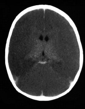 Hypoxia or diffuse edema